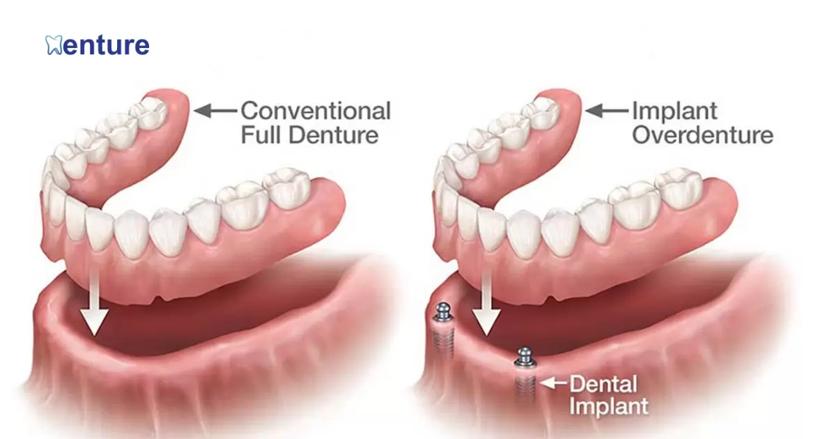 What's The Difference Between Dentures And Implants?
