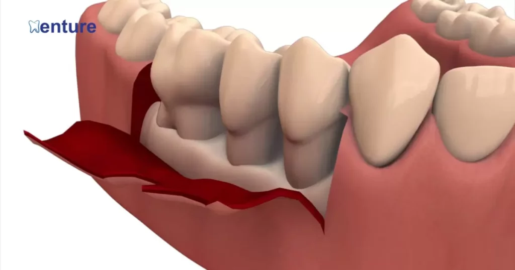 Will Dentures Cause Bone Loss?