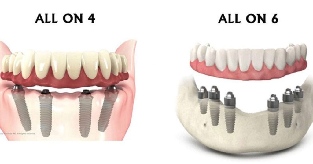 All-on-4 or All-on-6 Dentures