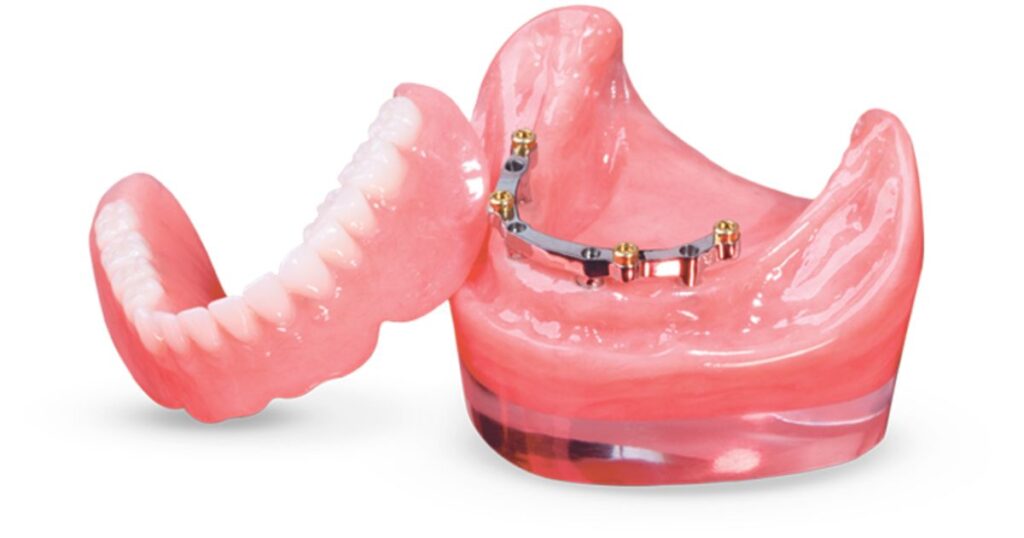 Bar-Retained Dentures
