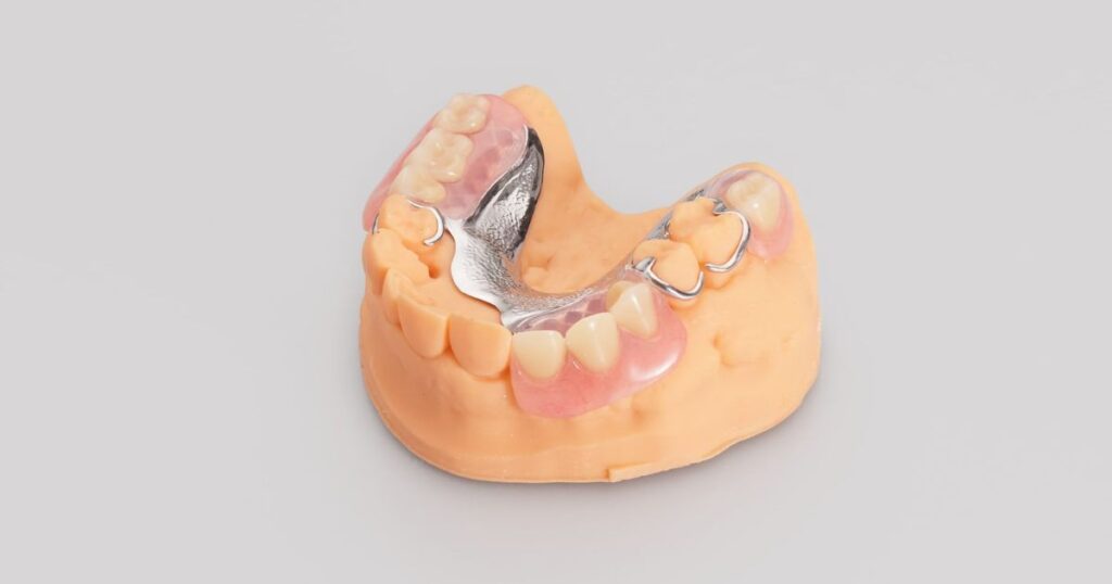 Cast Metal Partial Dentures
