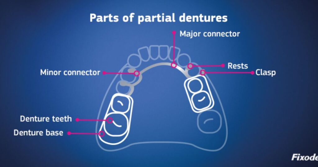 Components of Upper Partial Dentures