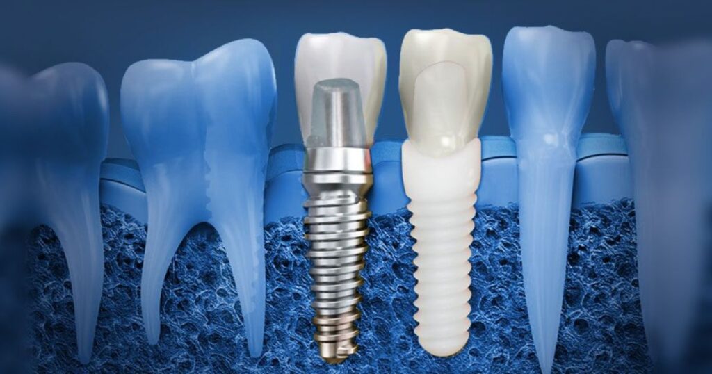 Cost Considerations for Dentures and Implants