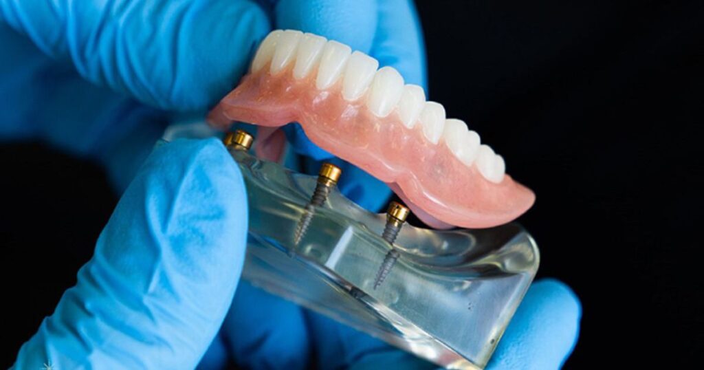 How Snap-In Dentures Work Exploring the Mechanics