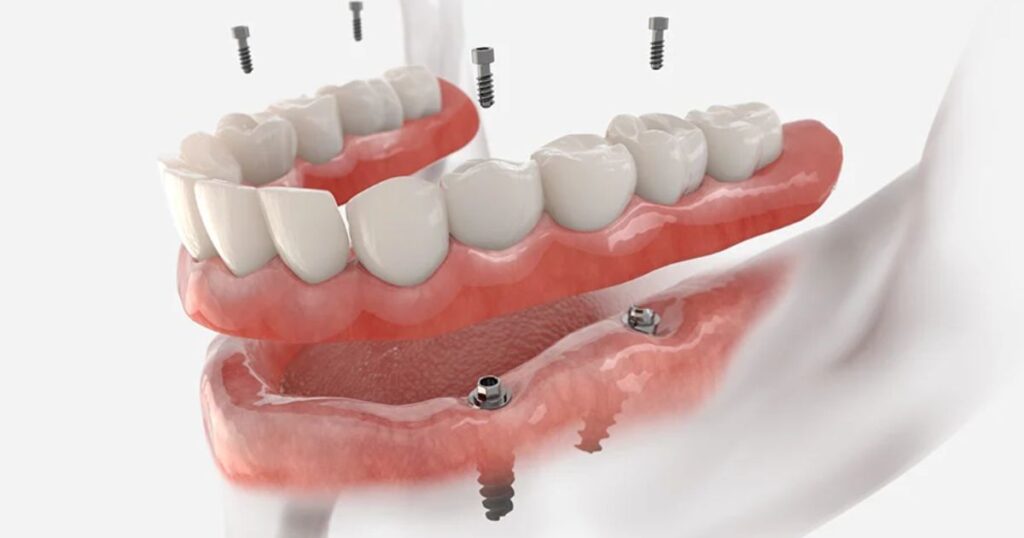 Maintaining and Caring for Implant-Supported Dentures