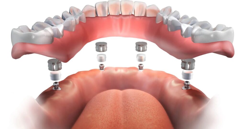 The Procedure Getting Snap-In Dentures