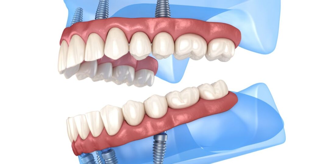 The Process of Getting Implant Dentures Explained