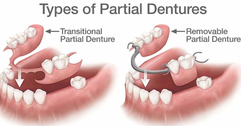 Types and Materials of Partial Dentures