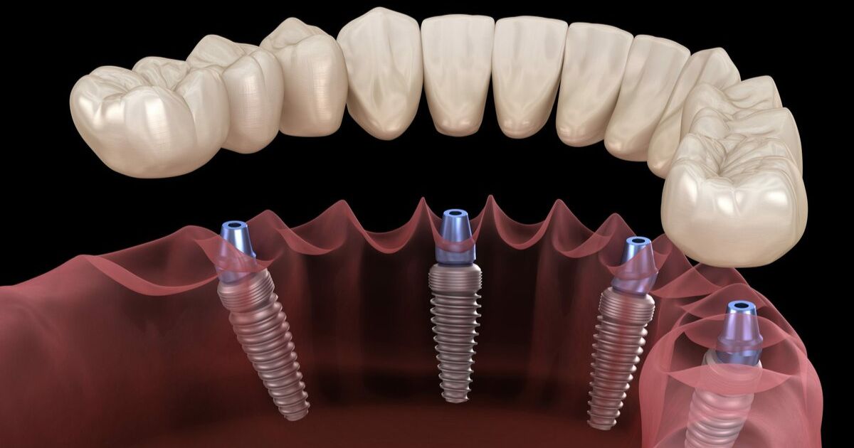 Building Your Implant Restoration