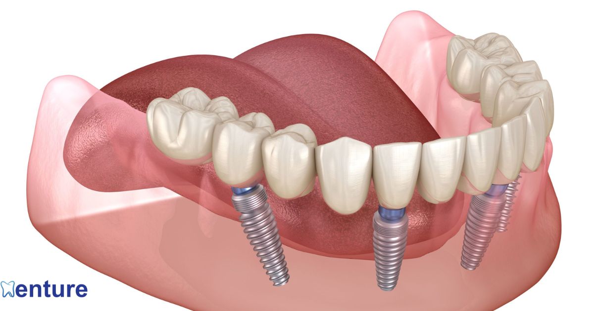 Comparing Implants and Dentures