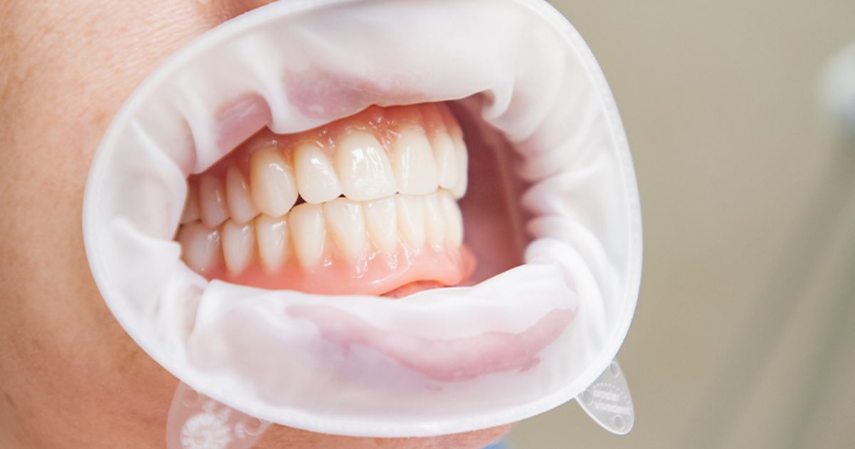 How Long Does It Take to Get a Denture Made?