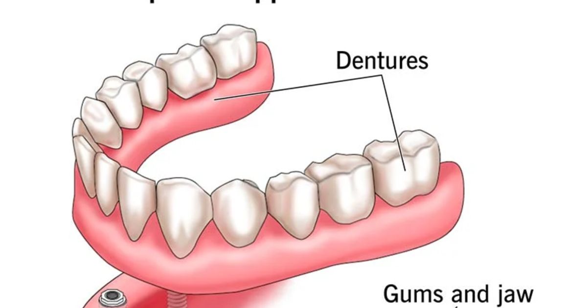 How Long Does It Take to Get Implant Dentures?