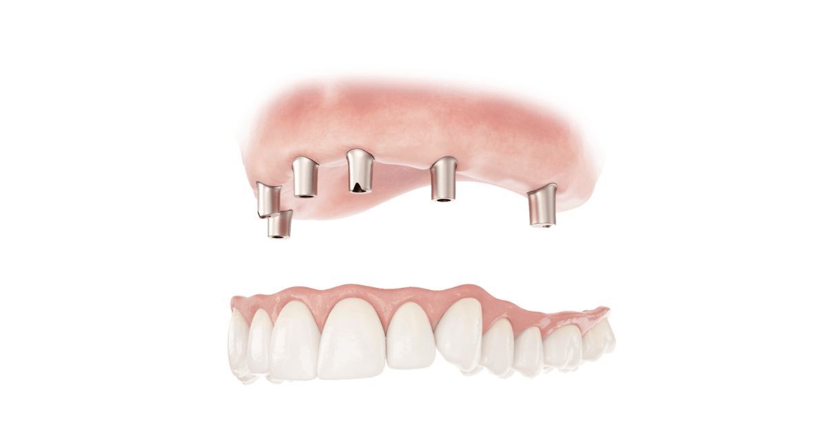 How Much Do Dentures Cost In Ontario?