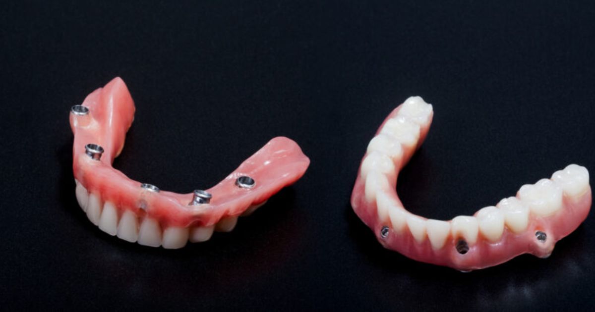 How Much Do Hybrid Dentures Cost?