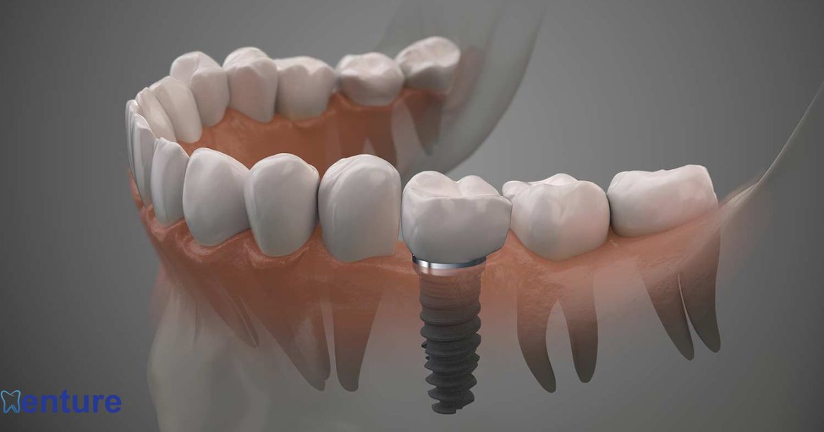 Which Is Better Implants or Dentures?
