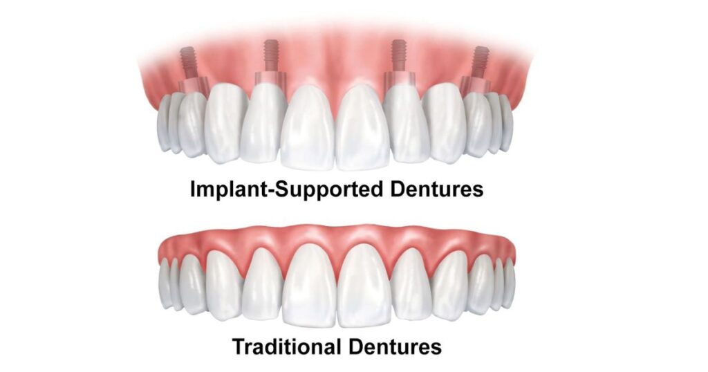 Comparing Permanent Dentures with Traditional Dentures