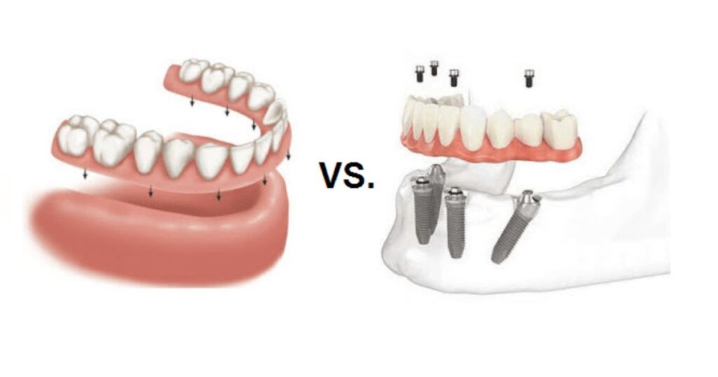 Dentures vs. Dental Implants Cost Comparison