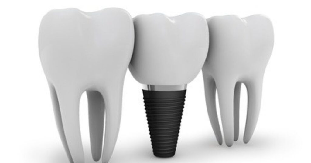 How Do The Costs Of Dental Implants Compare To Other Tooth Replacement Options
