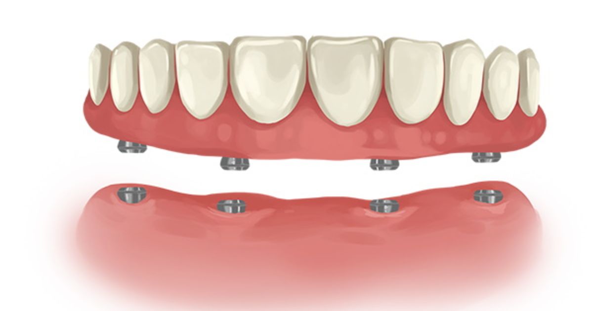 Implant Dentures Cost