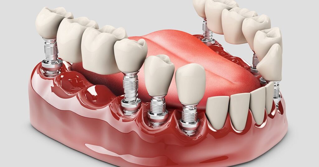 Types of Permanent Dentures