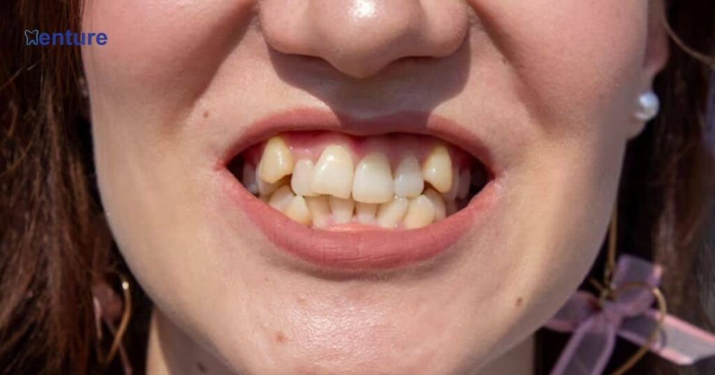 Filling in Gaps from Missing Teeth