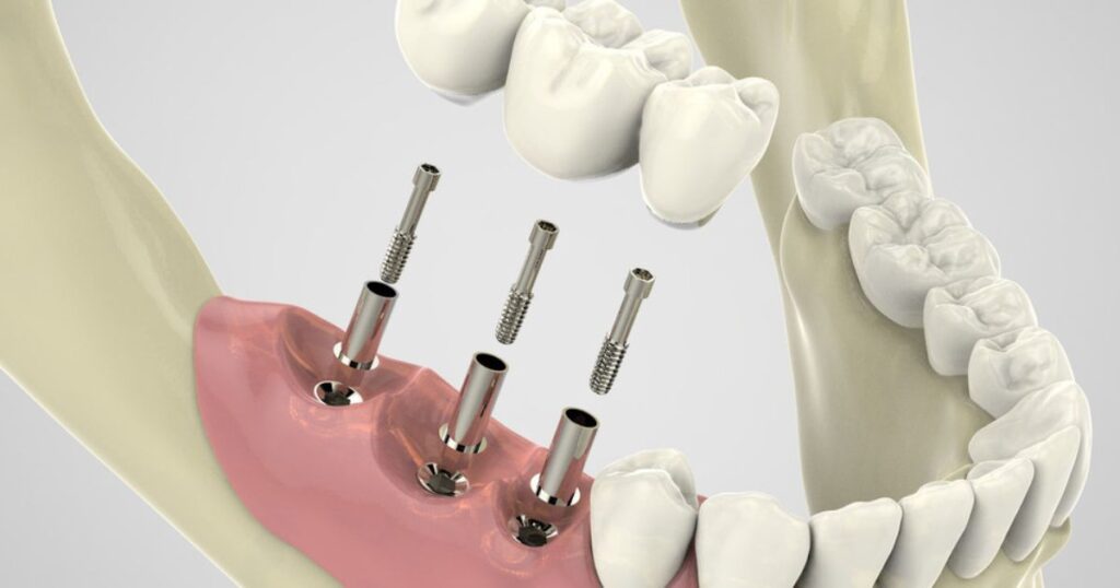 Custom dental crown attached on abutment over healed dental implant