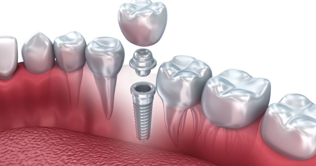 Custom dental implant abutment above the gumline