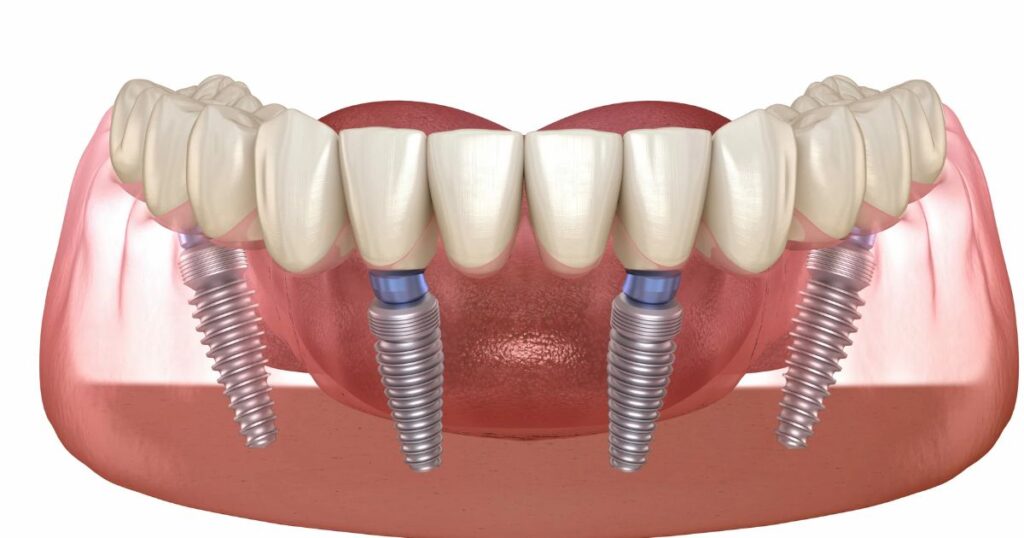 Full dental implant restoration with natural-looking prosthetic teeth
