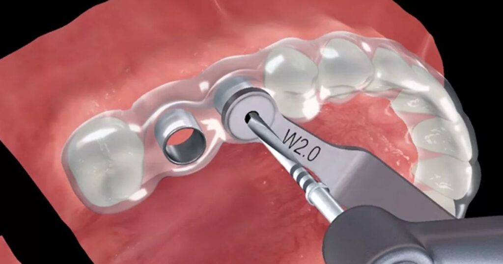 Surgical placement of the dental implant fixture in jawbone