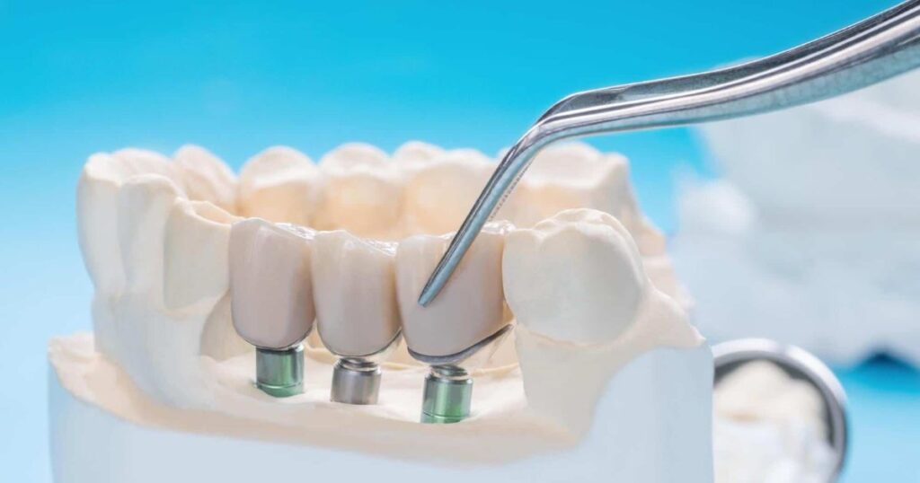 Understanding the Concept of $399 Dental Implants