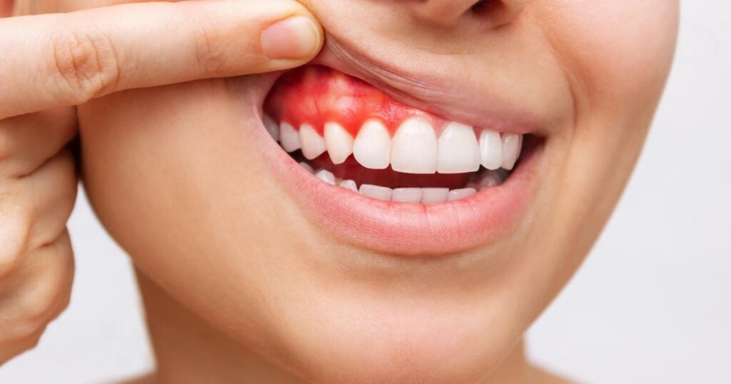 What Are Tooth Infections and What Causes Them