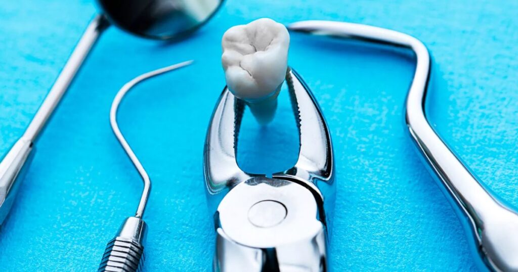What to Expect After Tooth Extraction Surgery