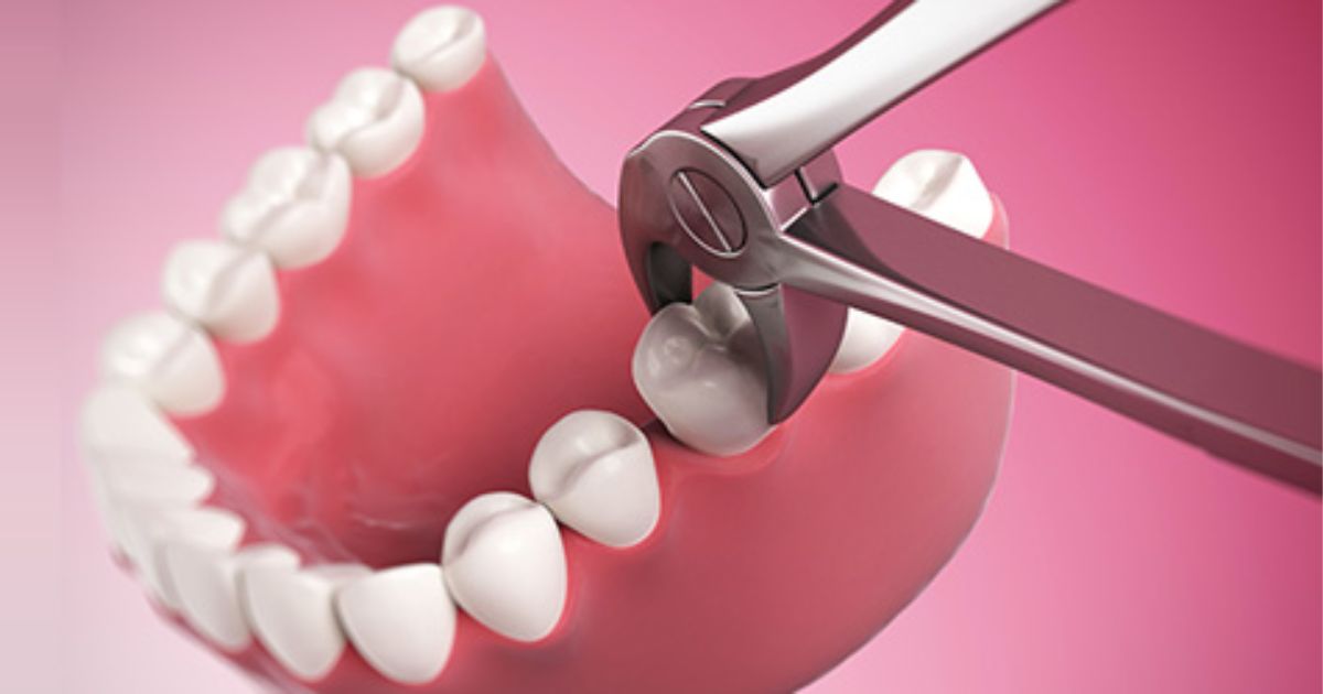 Wisdom Tooth Extraction Aftercare: Dos and Don’ts