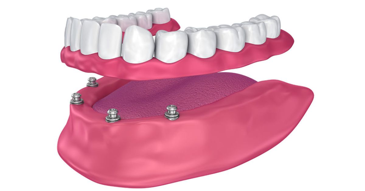 Affordable Denture Implants