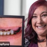 Before and After Dentures: Regaining Your Smile and Confidence