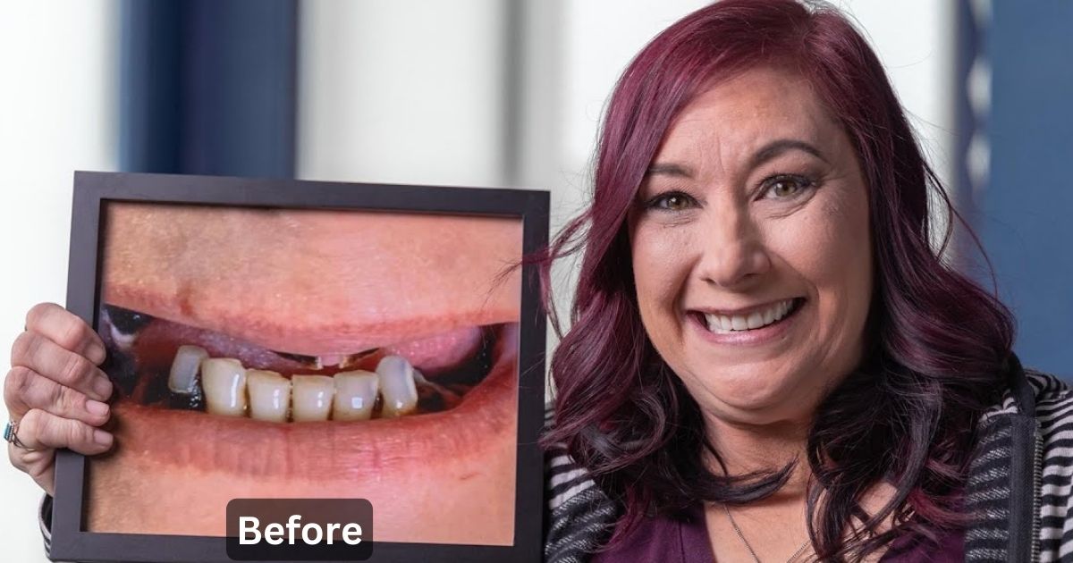 Before and After Dentures: Regaining Your Smile and Confidence