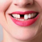 Cheap Options for Missing Teeth: Regaining Your Smile Without Breaking the Bank