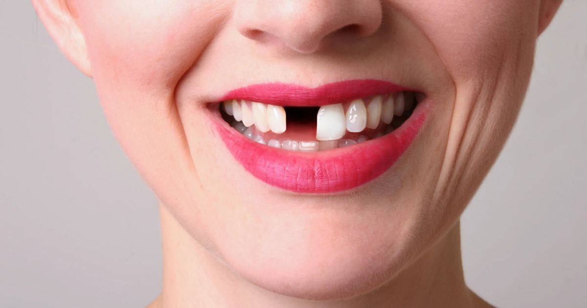 Cheap Options for Missing Teeth: Regaining Your Smile Without Breaking the Bank