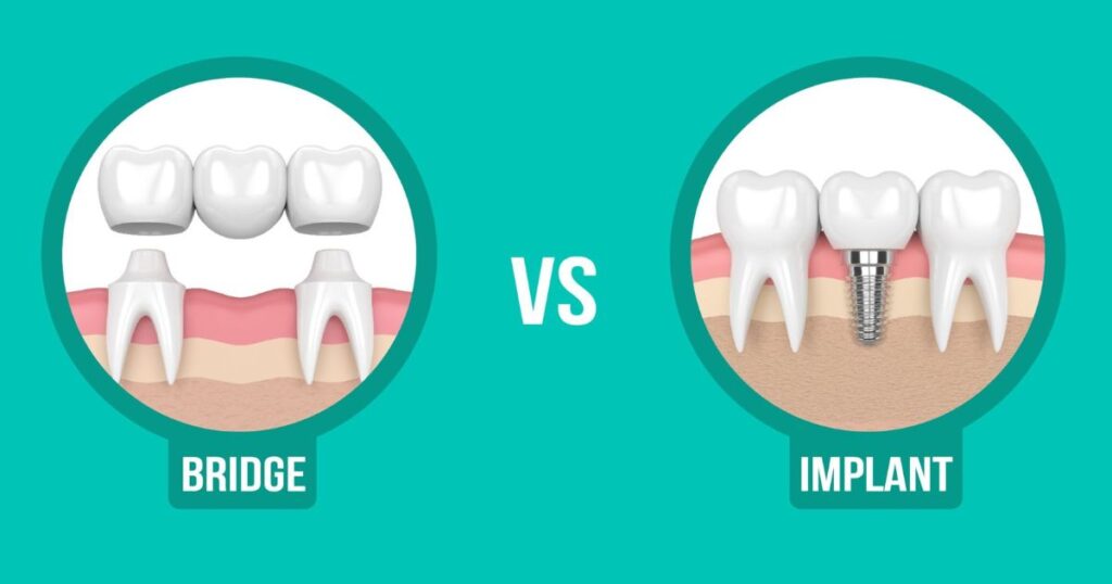 Lifespan of Dental Implants vs Other Tooth Replacements
