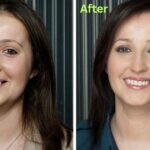 Dental Implants Before and After: Transforming Smiles in America