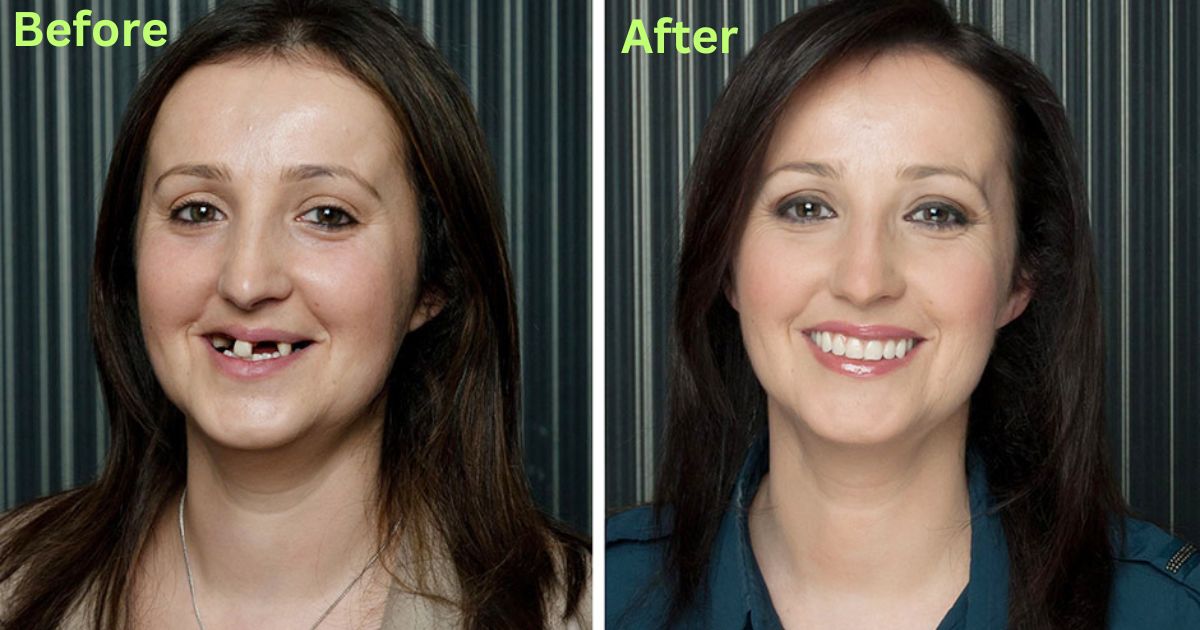 Dental Implants Before and After: Transforming Smiles in America