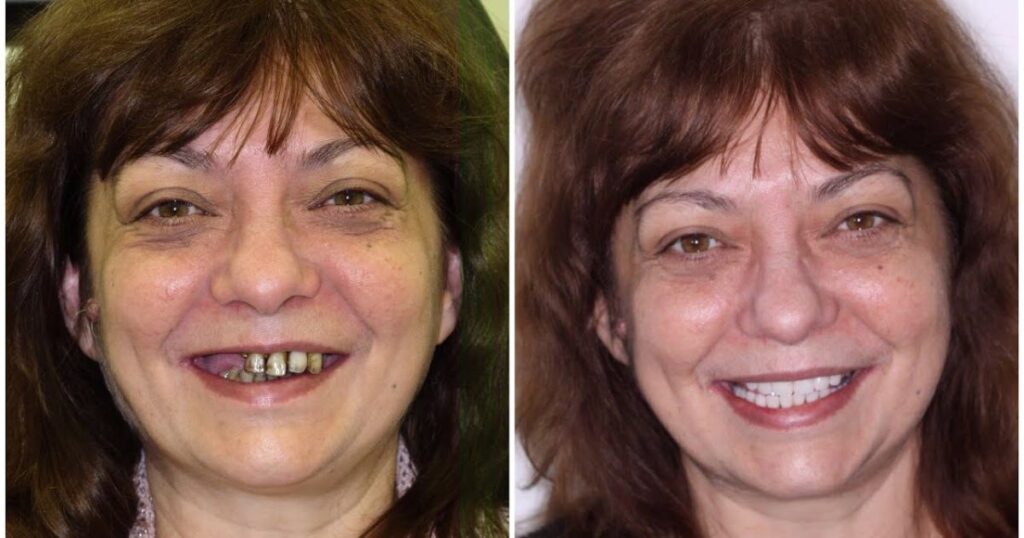 Real-Life Stories and Testimonials: Before and After Dentures