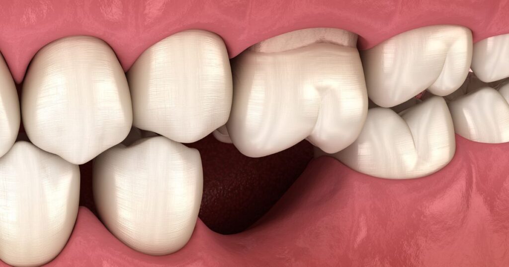 The Impact of Missing Teeth